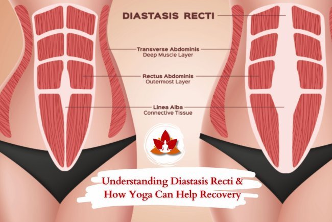 Understanding Diastasis Recti & How Yoga Can Help Recovery