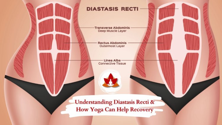 Understanding Diastasis Recti & How Yoga Can Help Recovery